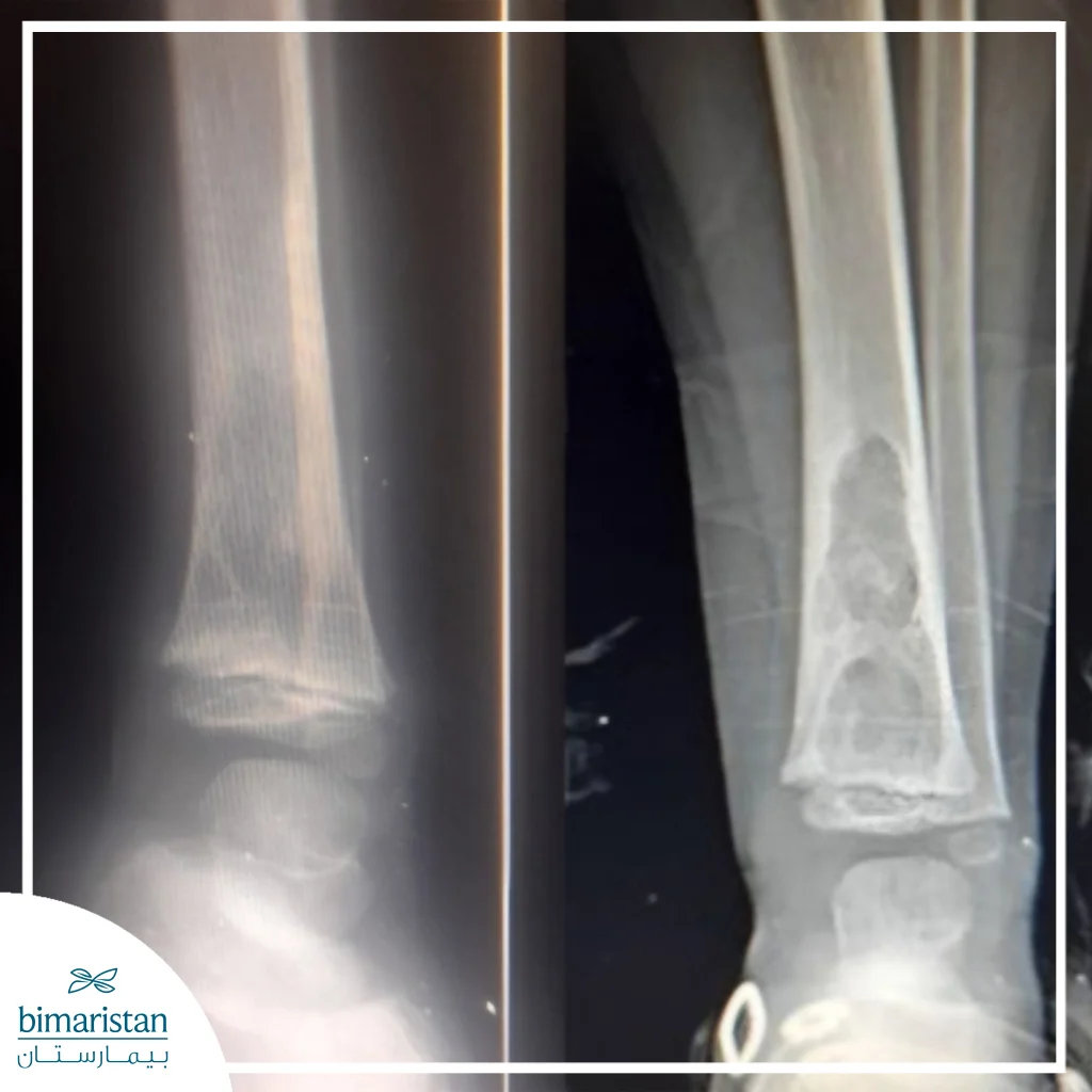 Extrapulmonary Tuberculosis: Types, Symptoms, And Different Treatment Methods 4 X-Ray Showing A Lytic Lesion In The Distal Tibia In A Patient With Bone Tuberculosis
