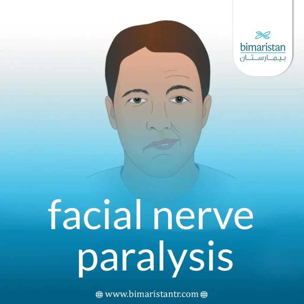 Facial Nerve Palsy: Causes And Treatment 5 Facial Nerve Paralysis