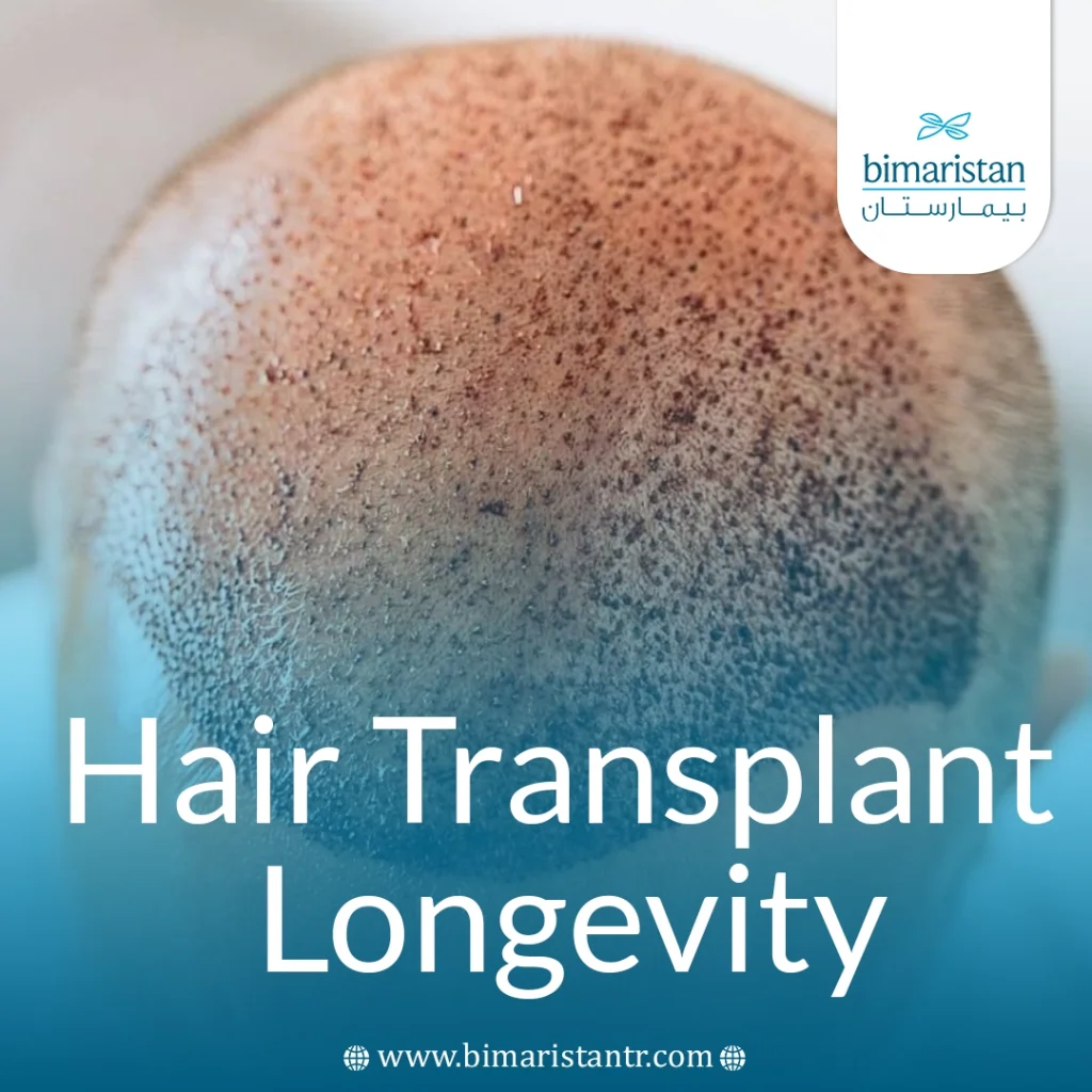 Hair Transplant Longevity