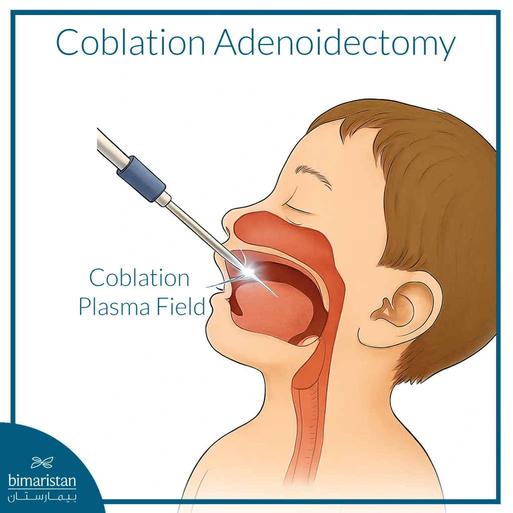 Treatment Of Enlarged Adenoids In Children 3 Illustration Showing Coblation Adenoidectomy