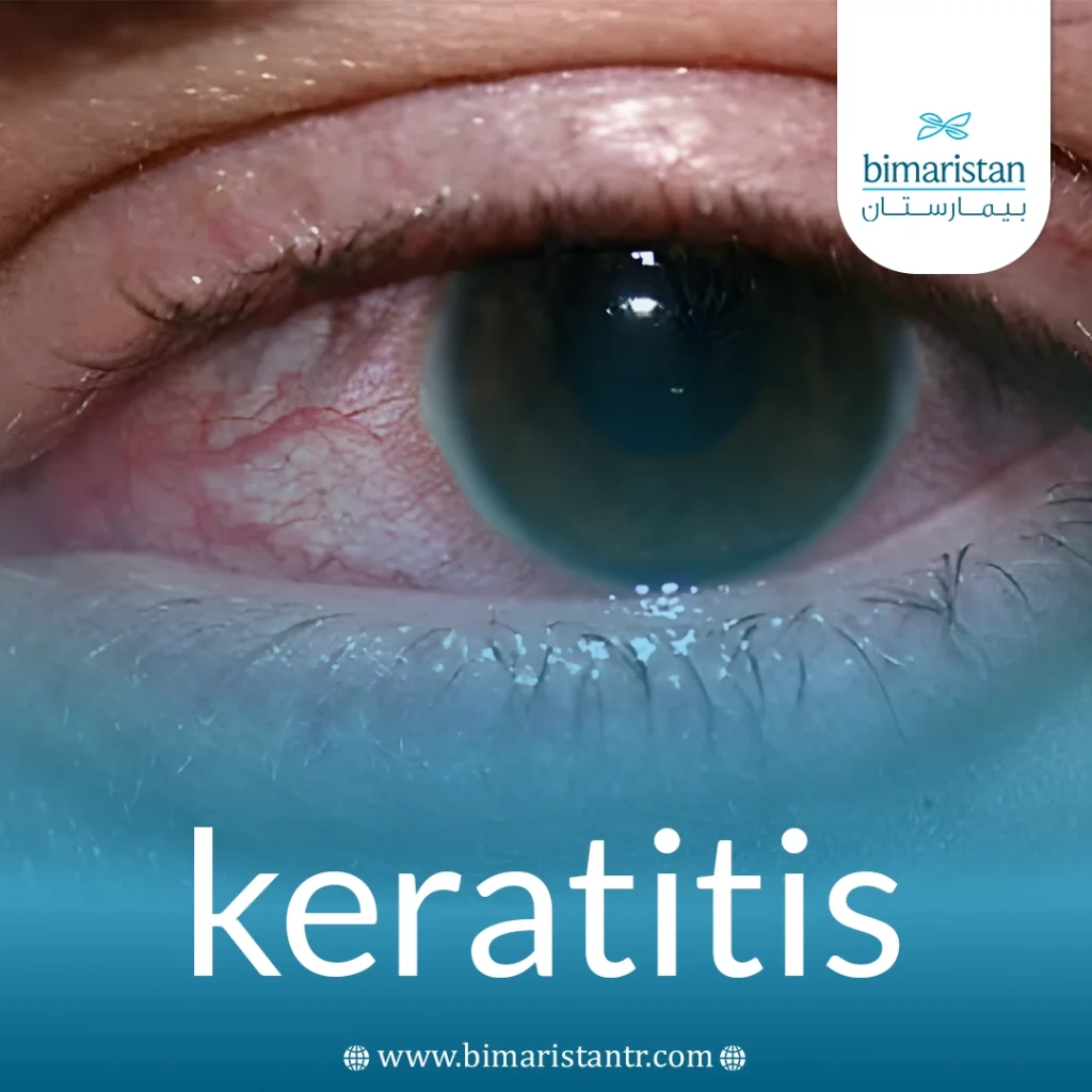 Keratitis: Discover Its Causes, Symptoms, And How It’s Treated 4 Keratitis