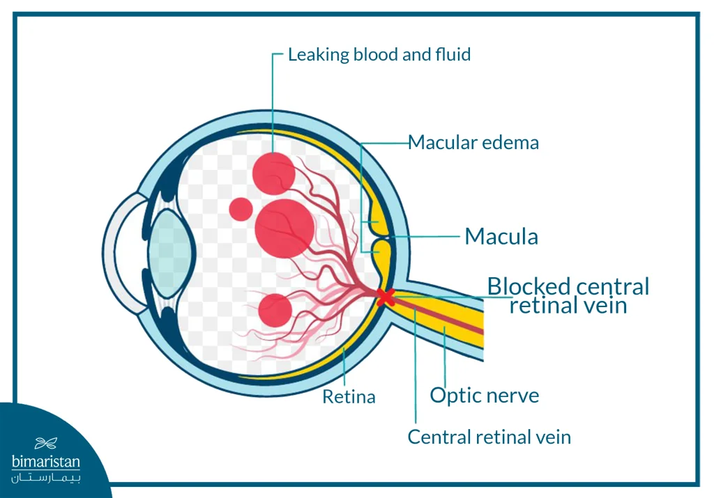 The Image Illustrating The Mechanism Of Central Retinal Vein Occlusion, Showing Blockage Of The Main Retinal Vein Leading To Blood And Fluid Leakage, Macular Edema, And Vision Loss.