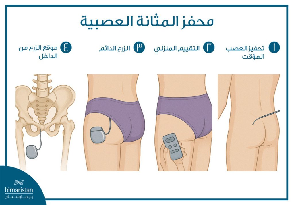خطوات تركيب بطارية المثانة العصبية