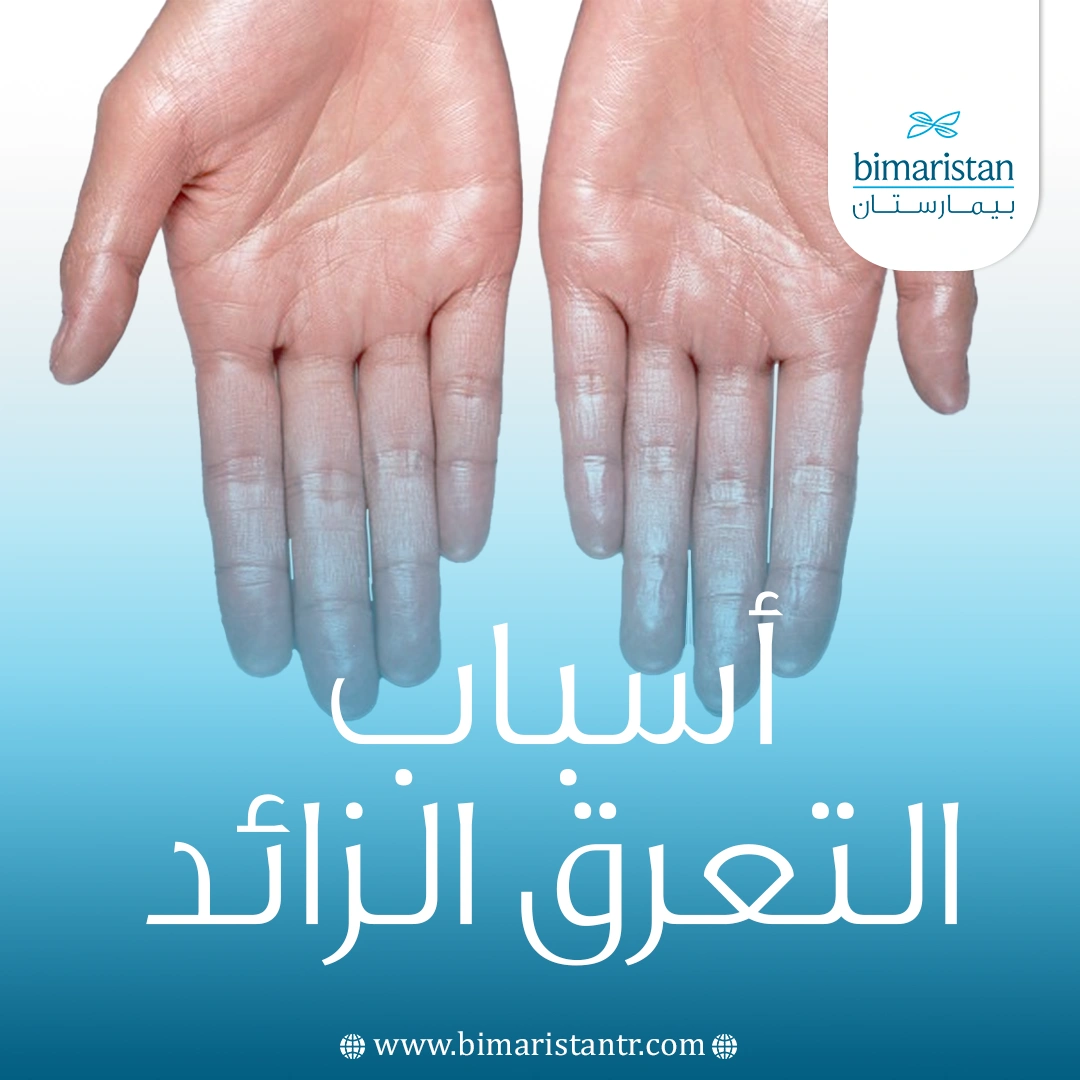 أسباب التعرق الزائد