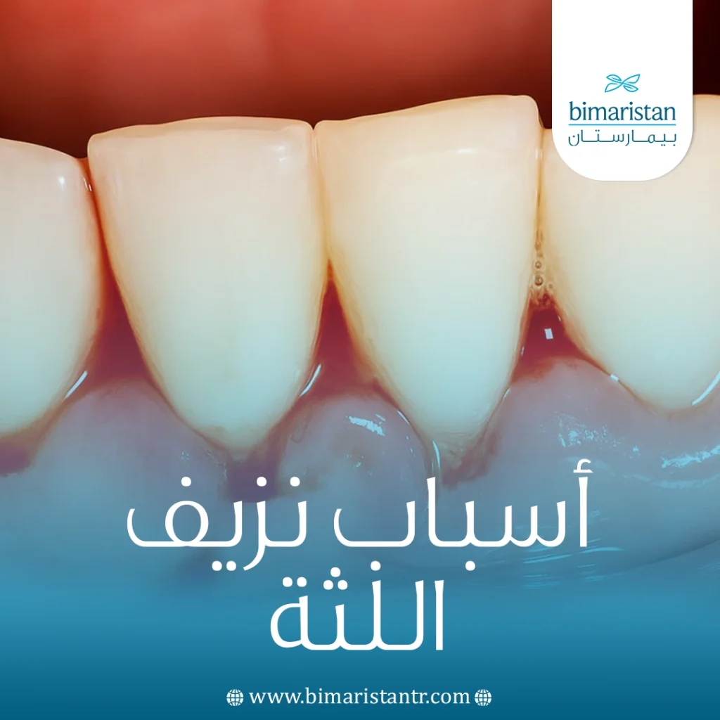 أسباب نزيف اللثة: علامة بسيطة أم إنذار لمرض خطير 5 أسباب نزيف اللثة