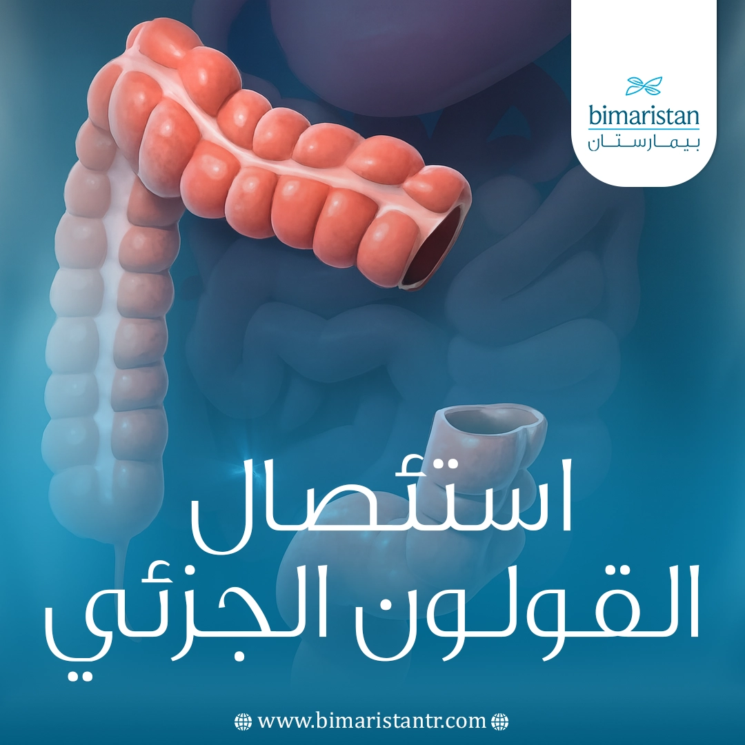 استئصال القولون الجزئي