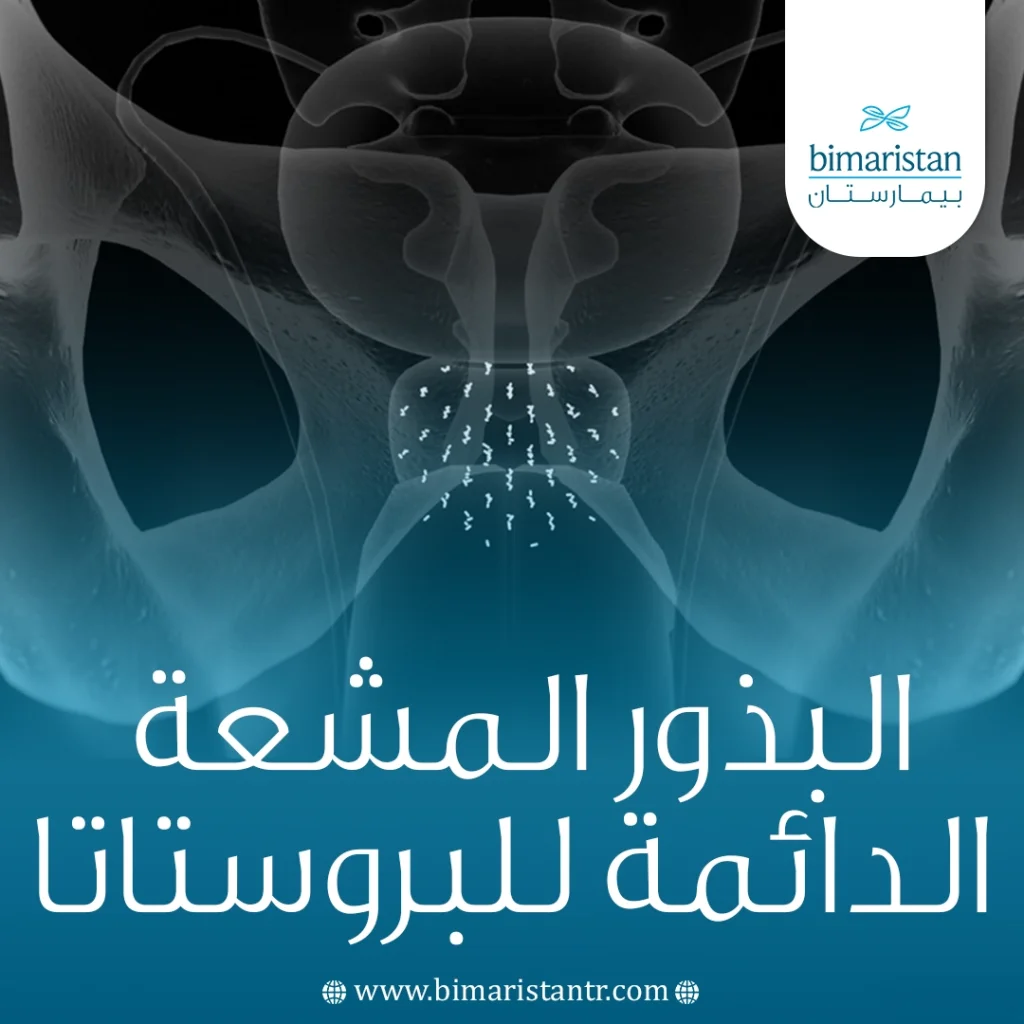 البذور المشعة الدائمة للبروستاتا: مراجعة شاملة 4 البذور المشعة الدائمة للبروستاتا