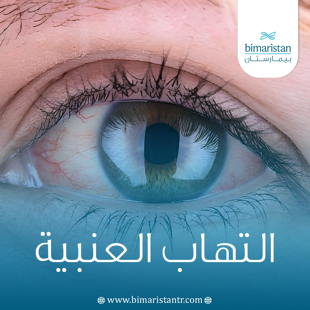 التهاب العنبية