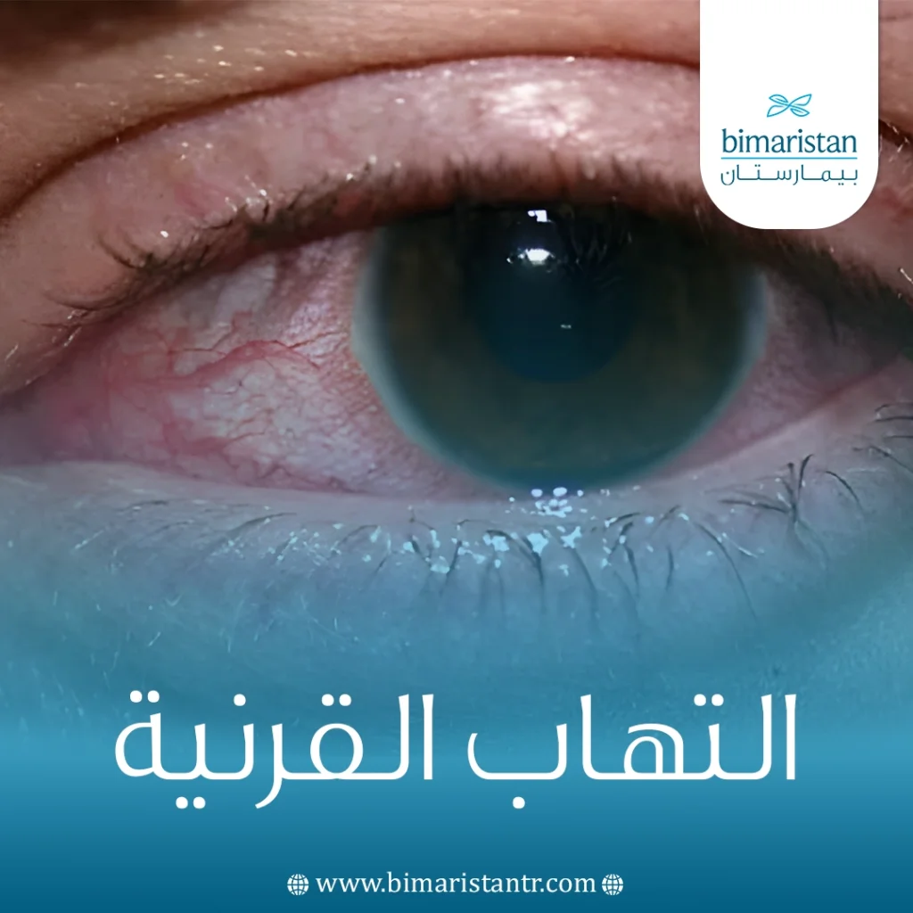 التهاب القرنية