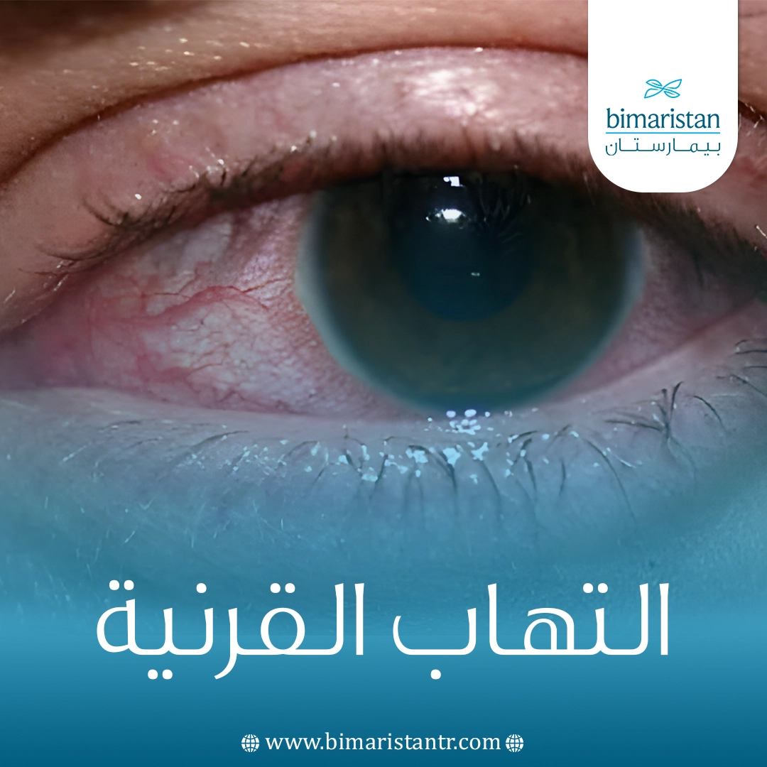 التهاب القرنية