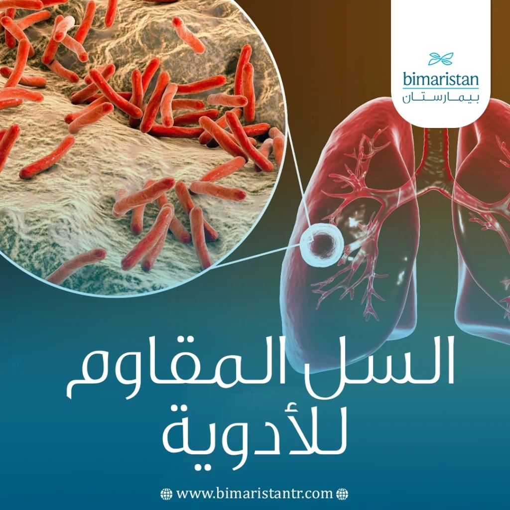 السل المقاوم للأدوية: الأسباب، الأعراض، والعلاج الحديث 6 السل المقاوم للأدوية