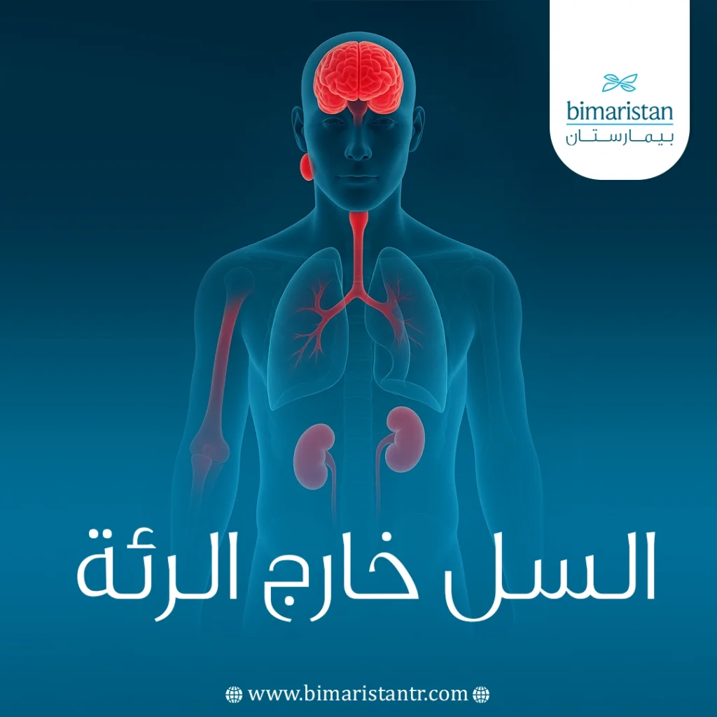 السل خارج الرئة: الأنواع، الأعراض، وطرق العلاج المختلفة 6 السل خارج الرئة