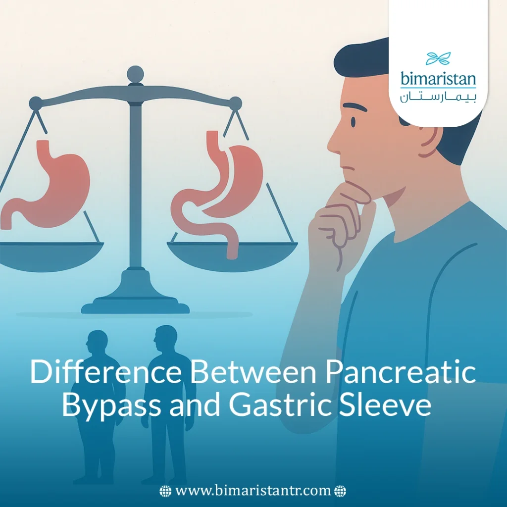 Difference Between Pancreatic Bypass And Gastric Sleeve Surgery