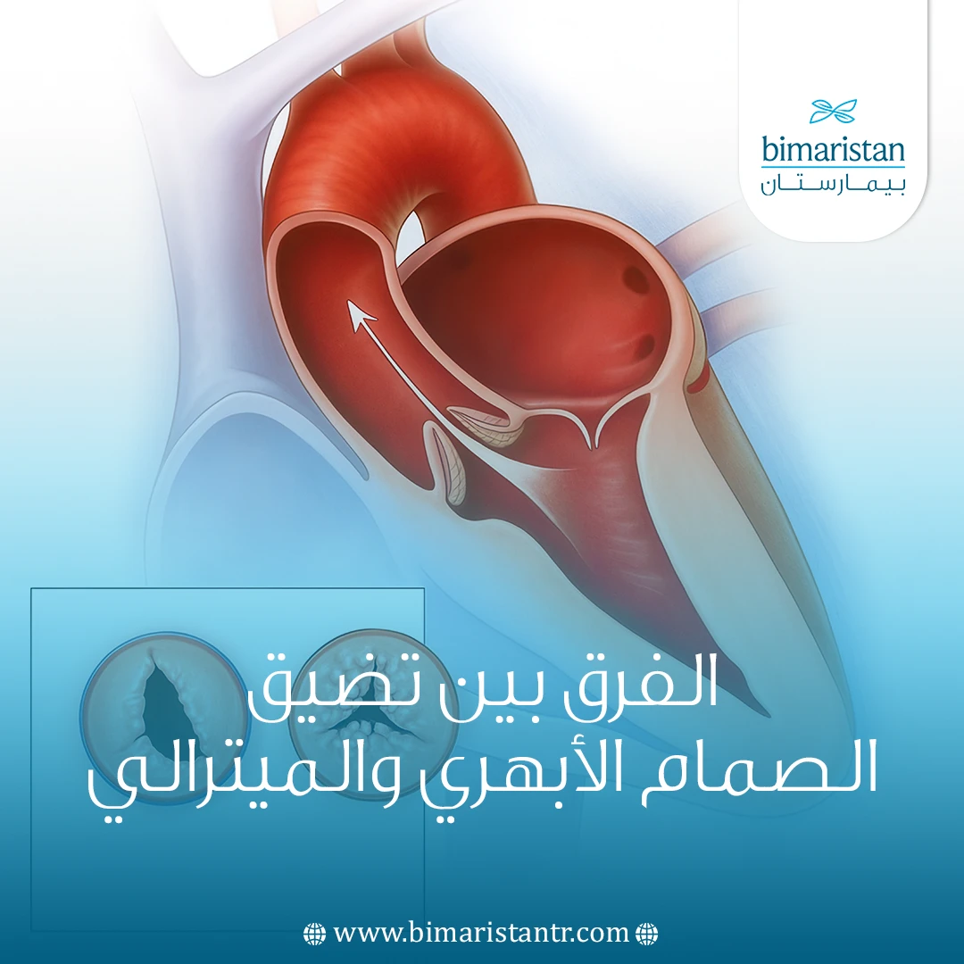 الفرق بين تضيق الصمام الأبهري والميترالي