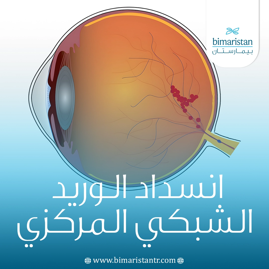 انسداد الوريد الشبكي المركزي