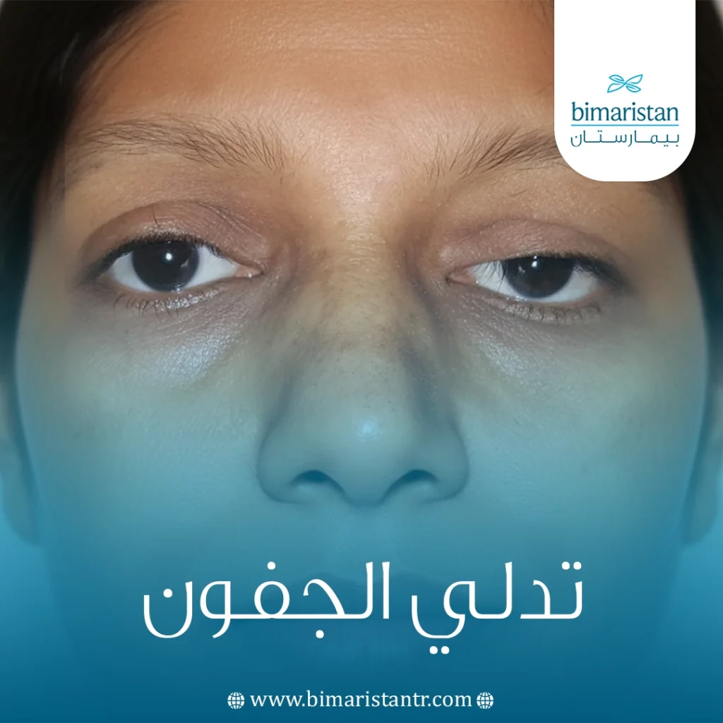 تدلي الجفون