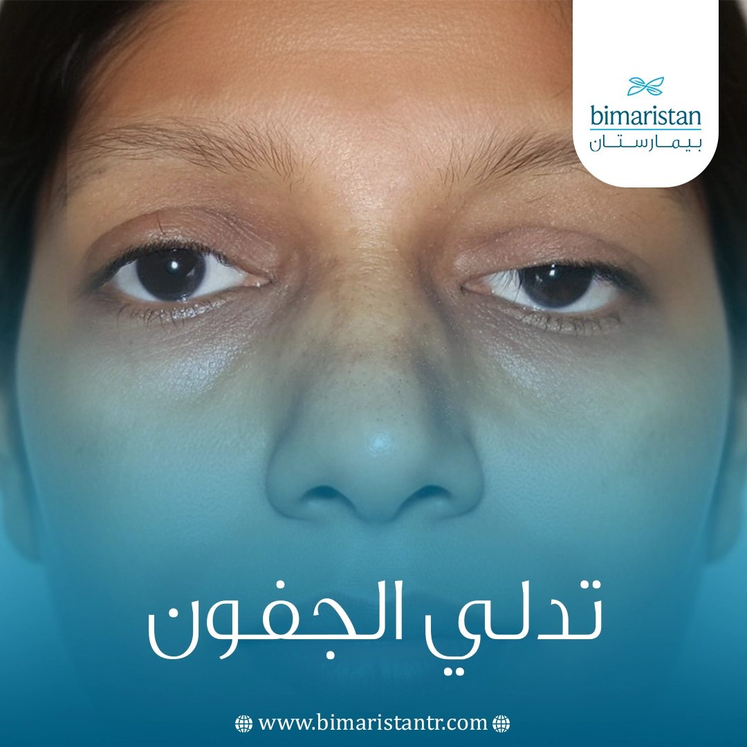 تدلي الجفون