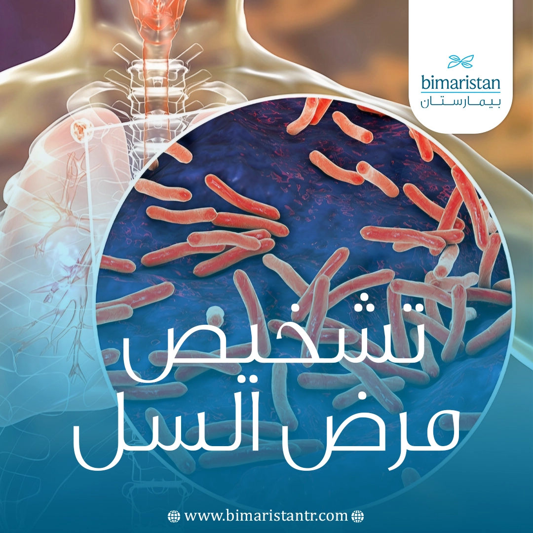 تشخيص مرض السل