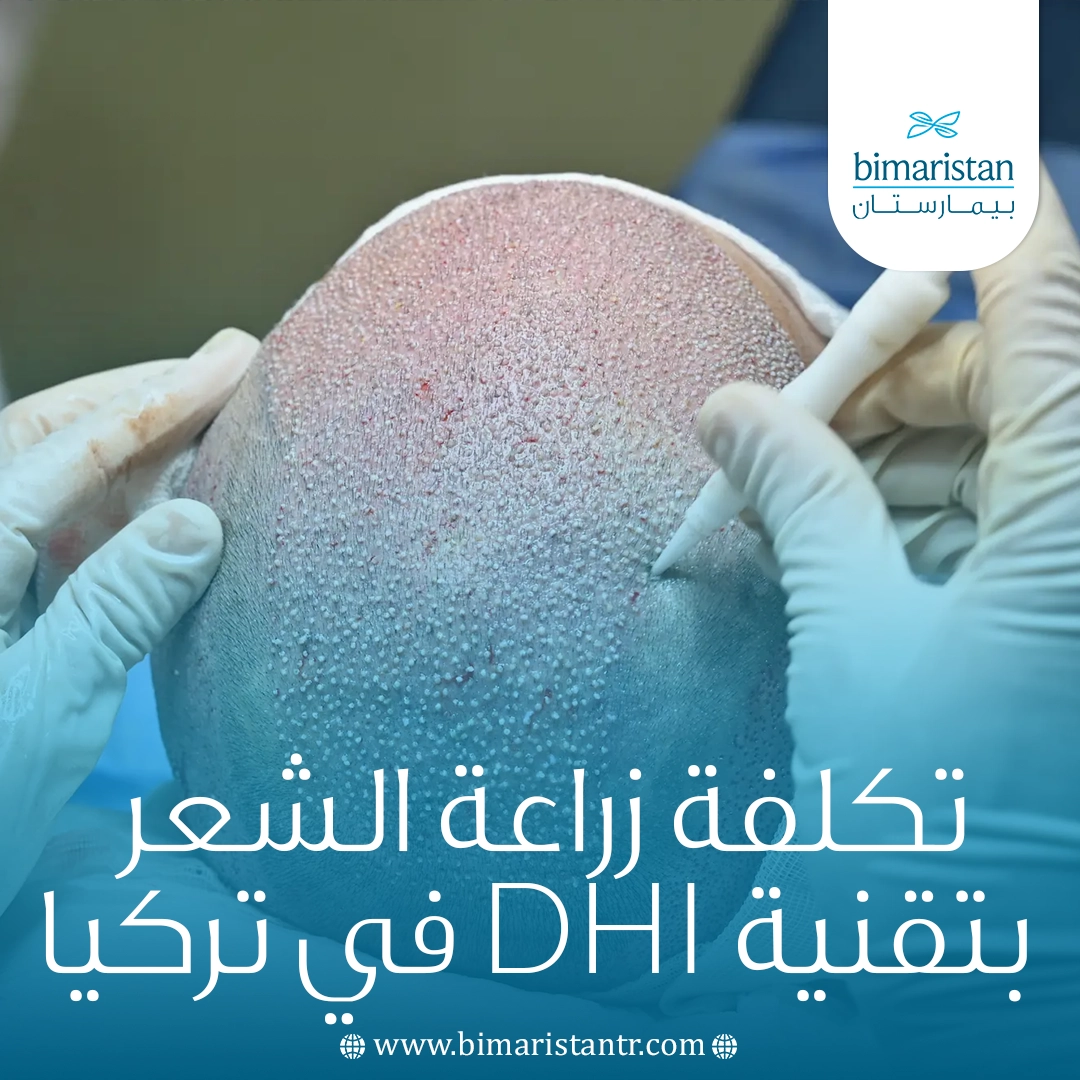 تكلفة زراعة الشعر بتقنية Dhi في تركيا 2025: الدليل الكامل للأسعار وأهم العوامل المؤثرة 6 تكلفة زراعة الشعر بتقنية Dhi في تركيا 2025: الدليل الكامل للأسعار وأهم العوامل المؤثرة
