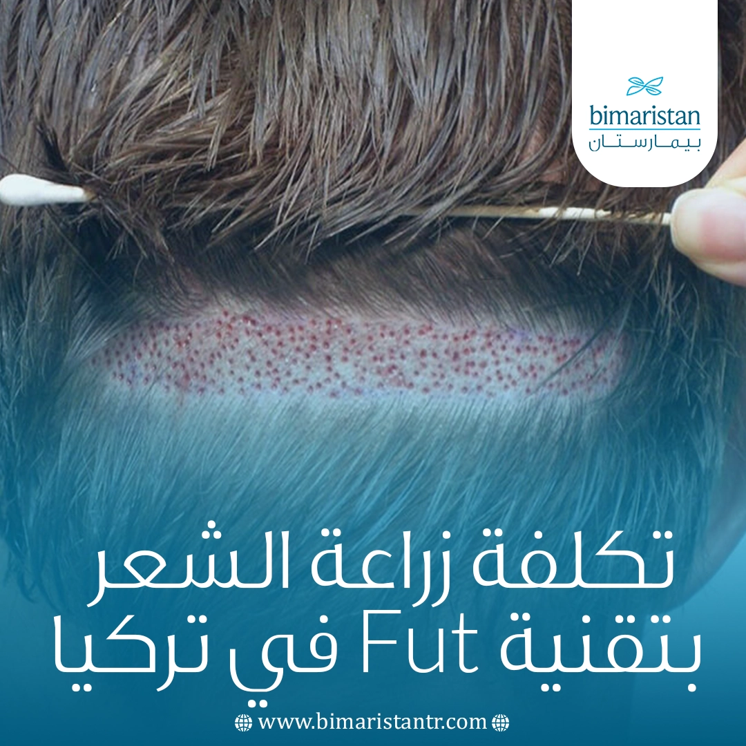 تكلفة زراعة الشعر بتقنية Fut في تركيا 2025: المميزات والخطوات والنتائج 8 تكلفة زراعة الشعر بتقنية Fut في تركيا 2025: المميزات والخطوات والنتائج