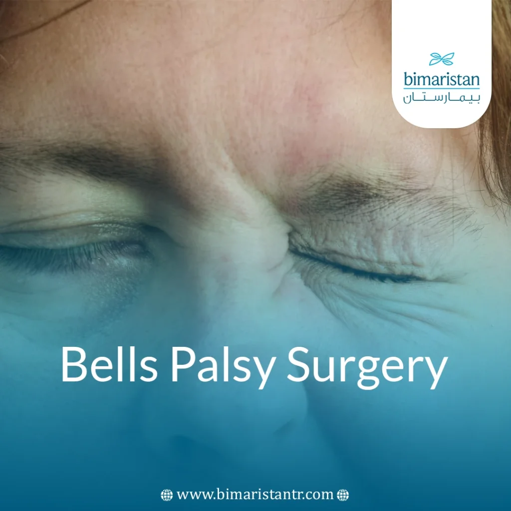 Bell'S Palsy Surgery