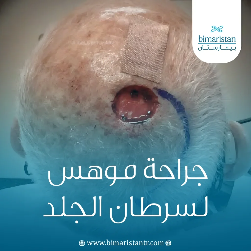 جراحة موهس لسرطان الجلد: خطوات العملية، المميزات، ونسب الشفاء 4 جراحة موهس لسرطان الجلد