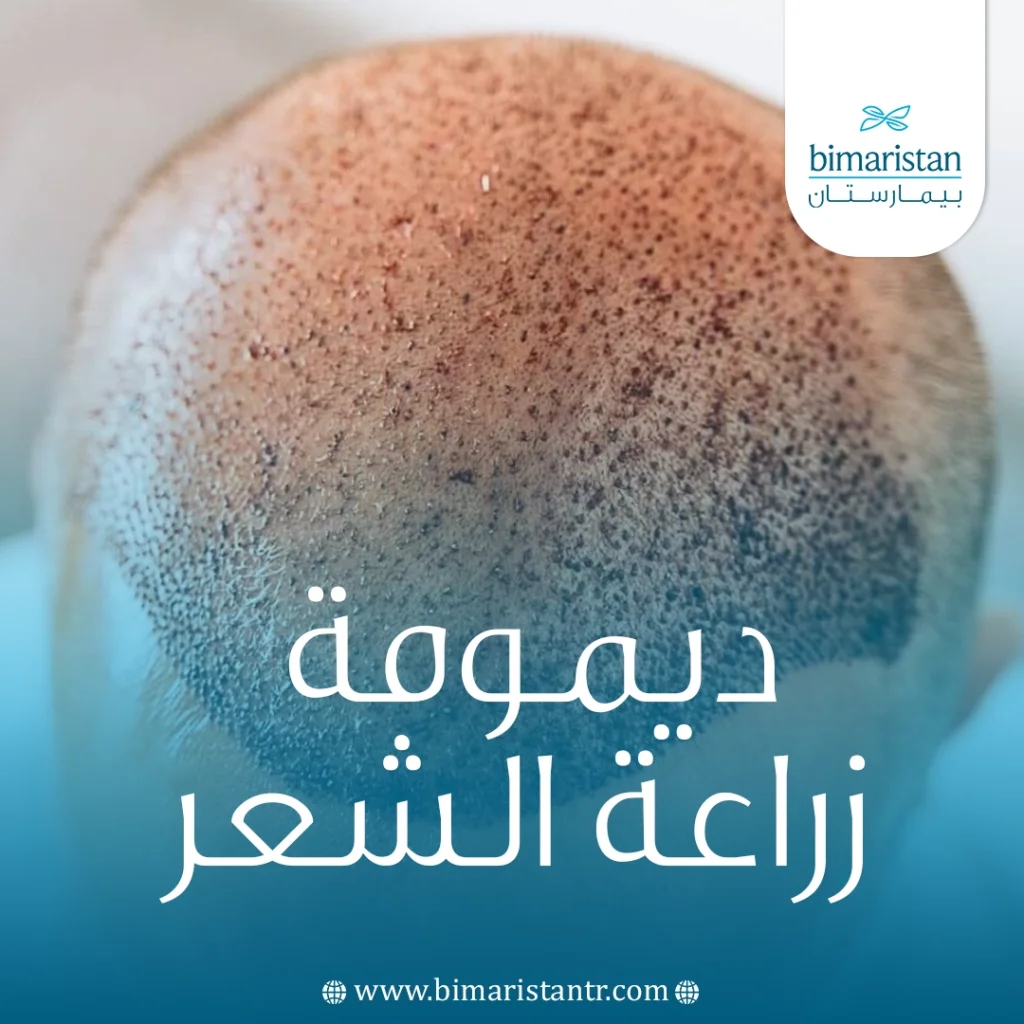 ديمومة زراعة الشعر: كيف يختلف عن الشعر الأصلي وأسرار الحفاظ عليه 4 ديمومة زراعة الشعر