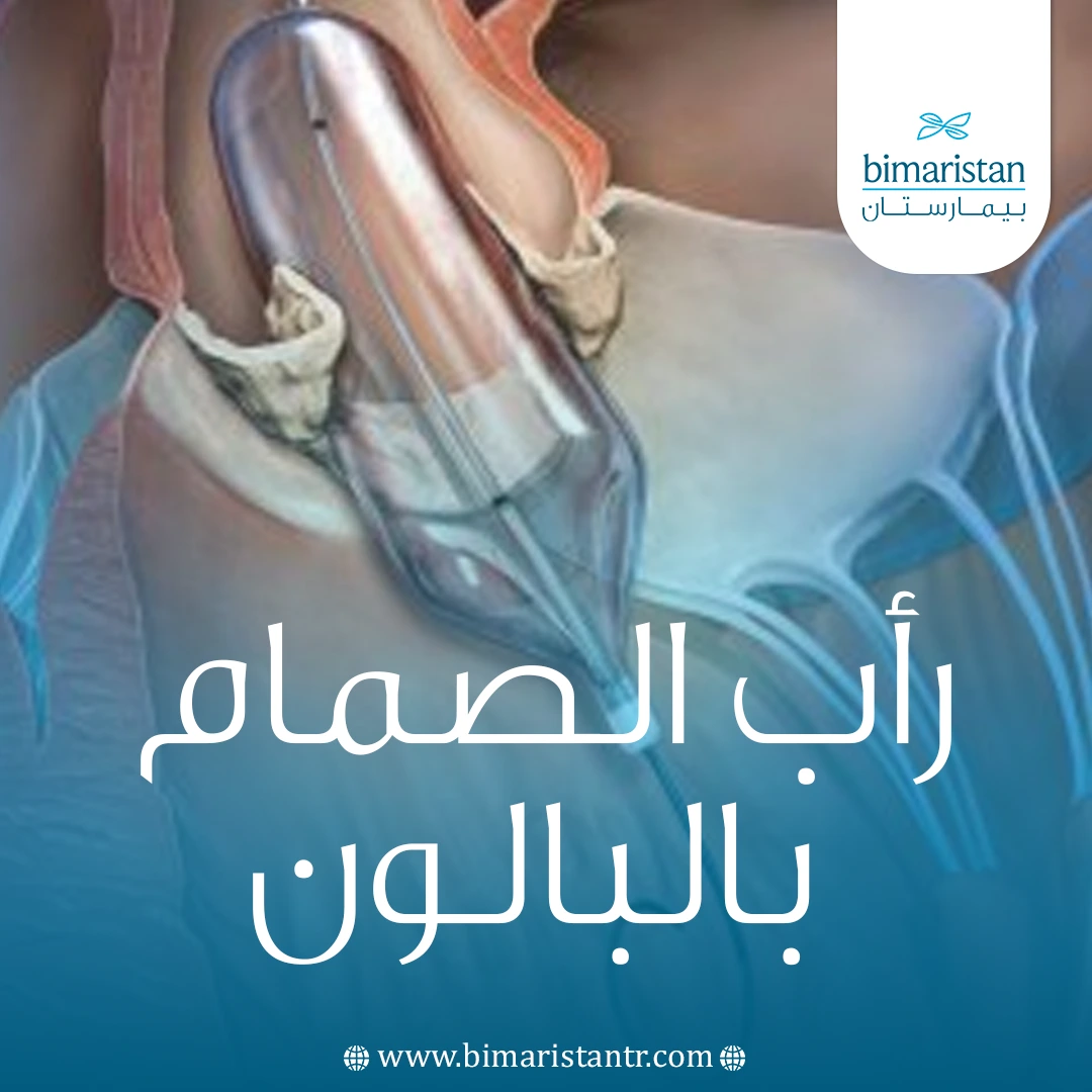 رأب الصمام بالبالون