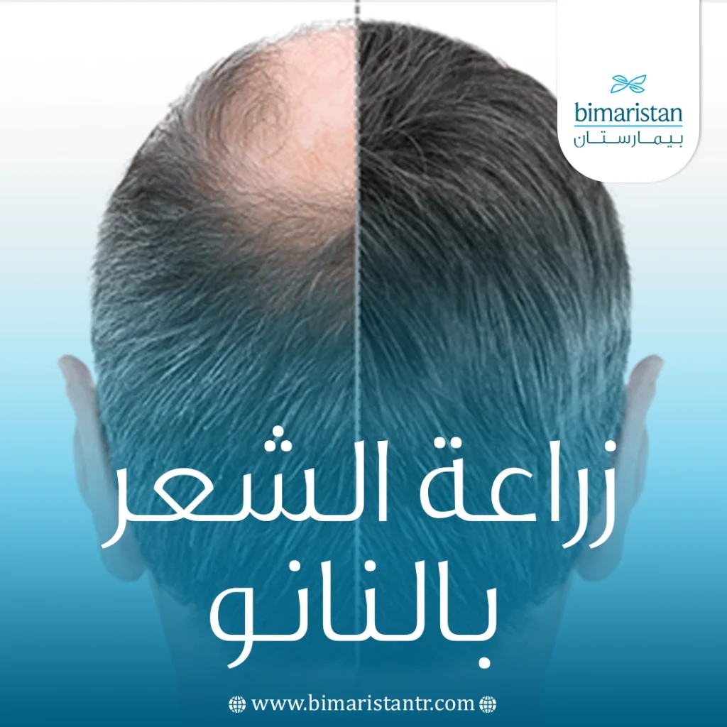 زراعة الشعر بالنانو: التقنية الأحدث لنتائج طبيعية وكثافة عالية 4 زراعة الشعر بالنانو