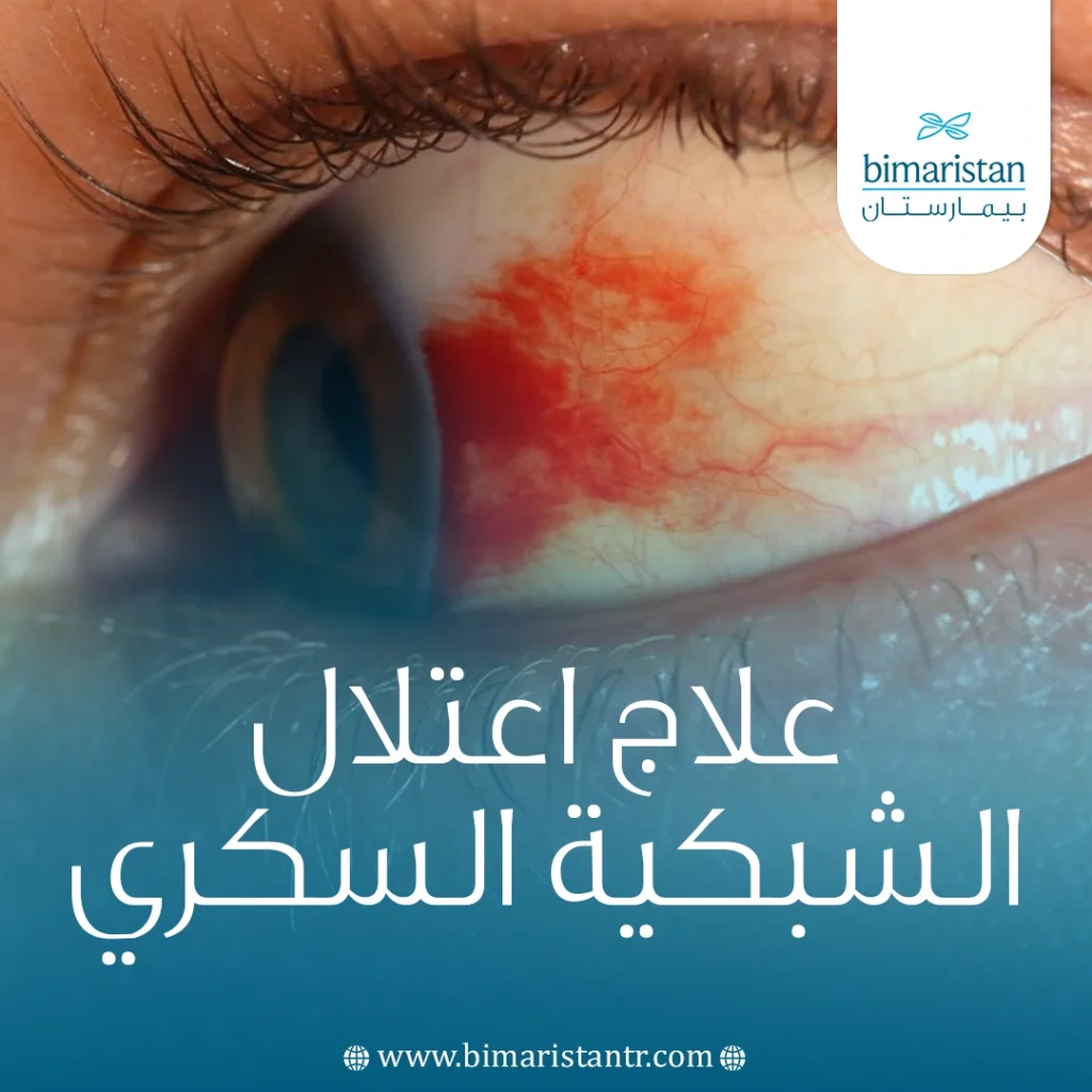 علاج اعتلال الشبكية السكري في تركيا: حماية البصر بتقنيات حديثة 4 علاج اعتلال الشبكية السكري