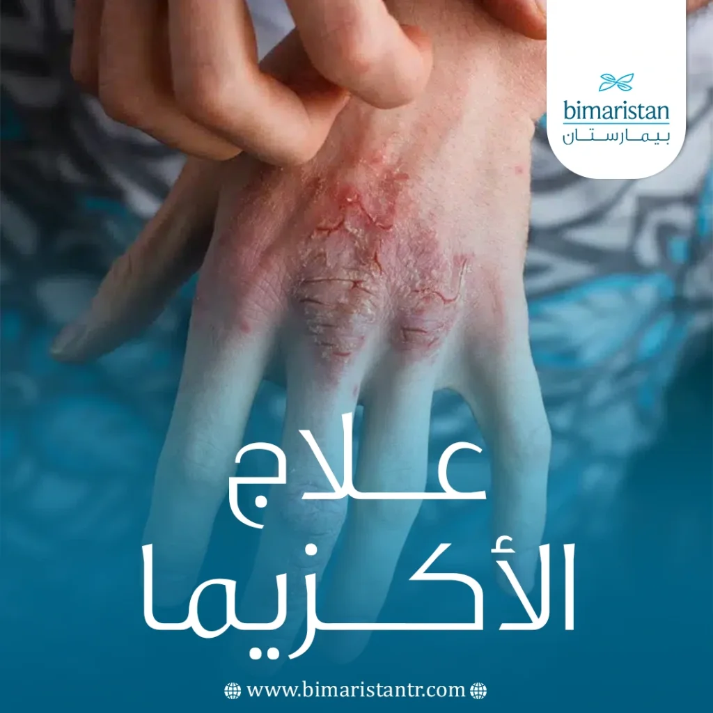 علاج الأكزيما