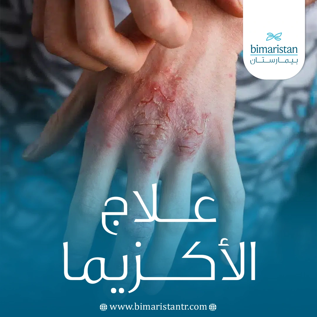 علاج الأكزيما