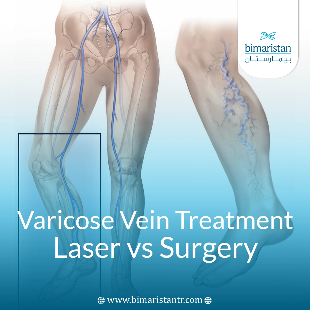 Laser Or Surgical Treatment For Varicose Veins