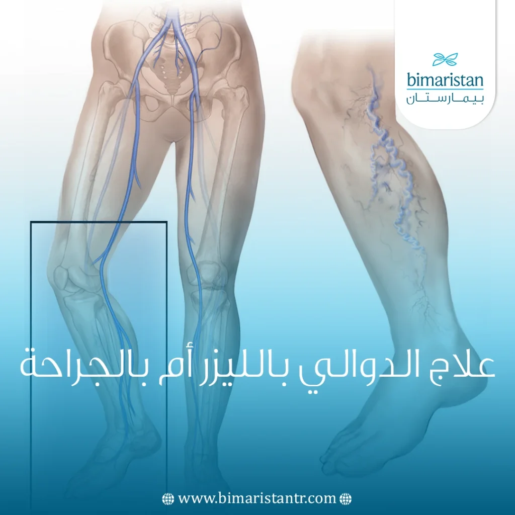 علاج الدوالي بالليزر أم بالجراحة