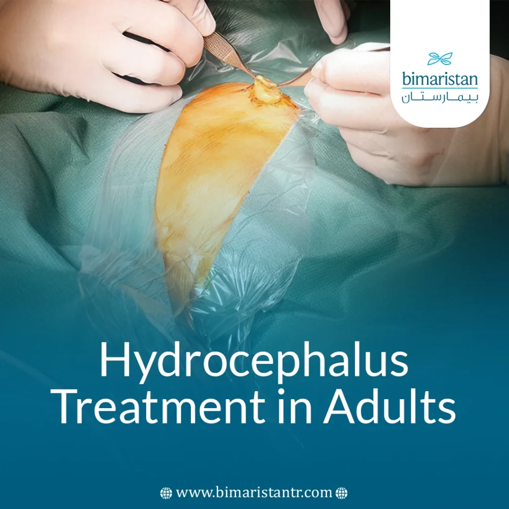 Hydrocephalus Treatment In Adults