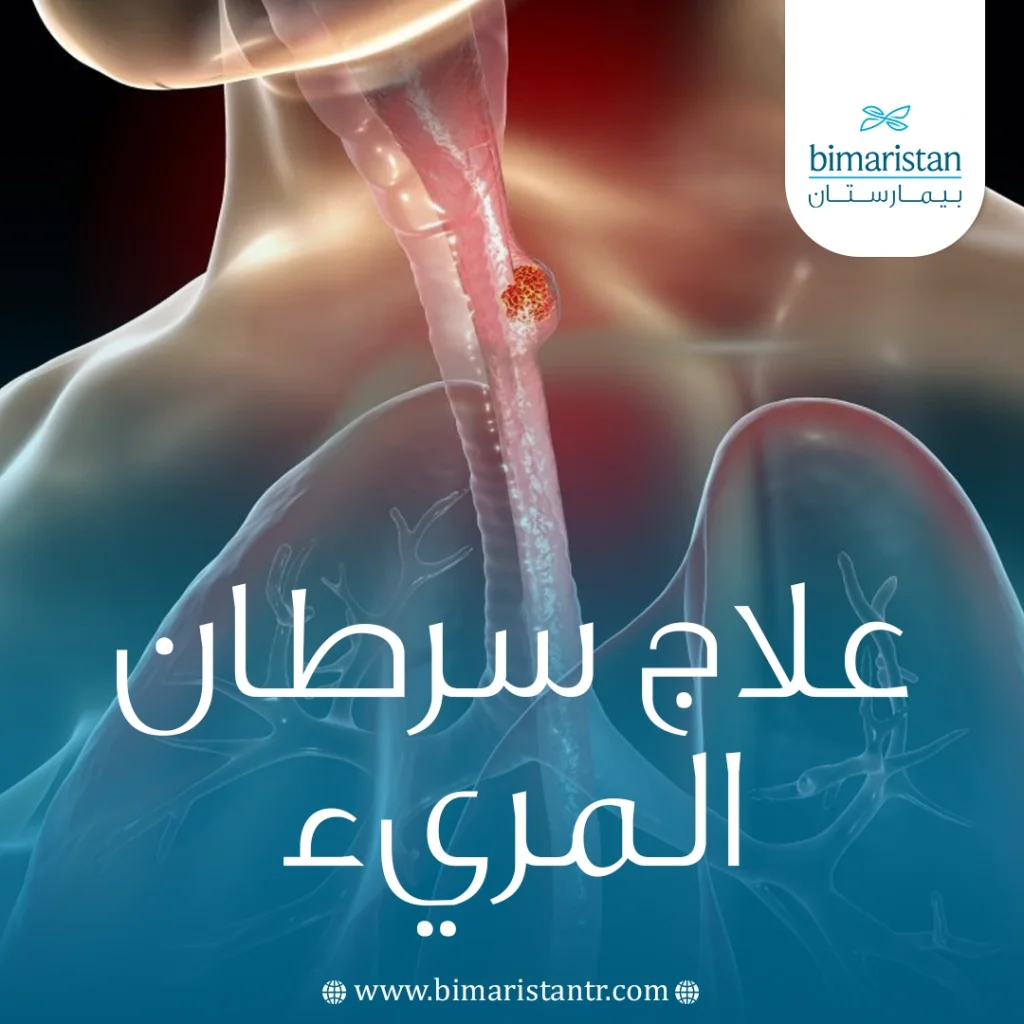 علاج سرطان المريء