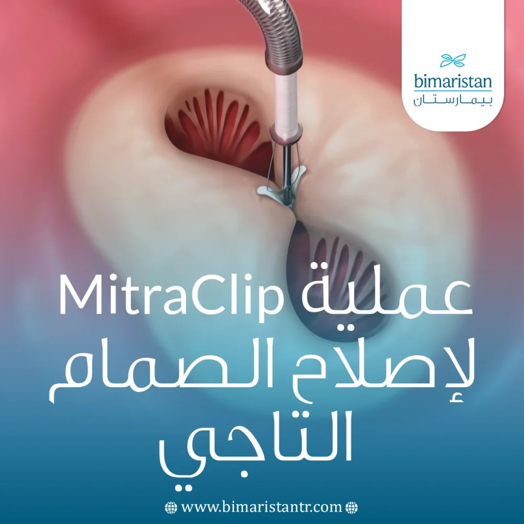 عملية Mitraclip لإصلاح الصمام التاجي: التقنية الحديثة لعلاج ارتجاع الصمام بدون جراحة مفتوحة 5 عملية Mitraclip لإصلاح الصمام التاجي