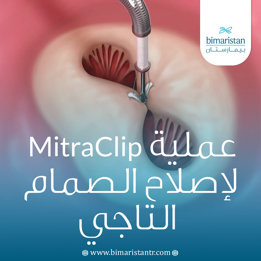 عملية Mitraclip لإصلاح الصمام التاجي