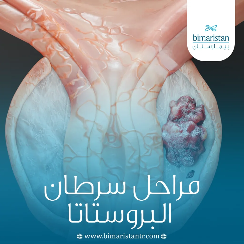 مراحل سرطان البروستاتا