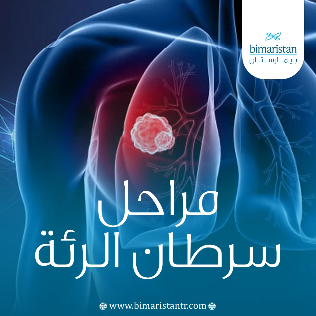 مراحل سرطان الرئة