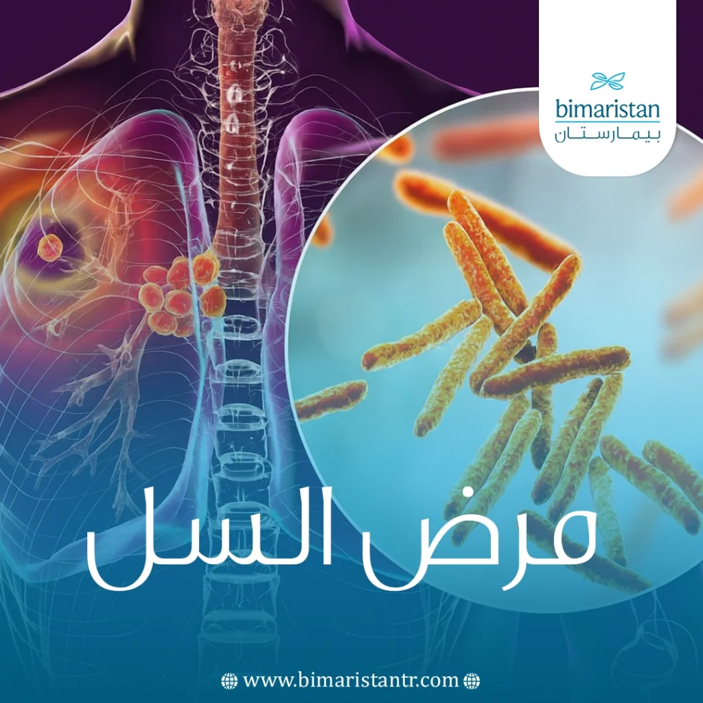 ما هو مرض السل؟ الأسباب، الأنواع، وآلية العدوى 6 مرض السل