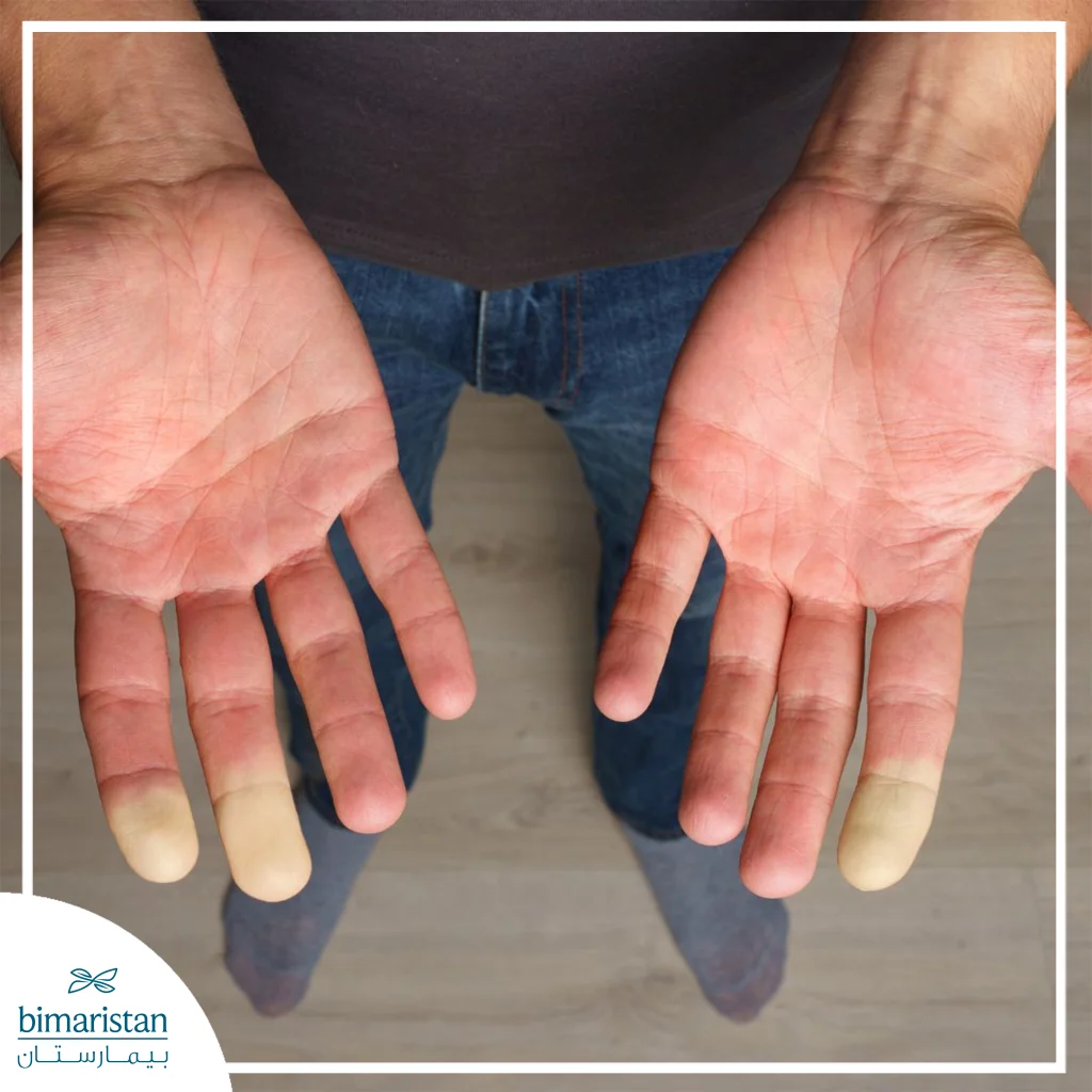 أصابع شاحبة بسبب انقباض الأوعية الدموية في مرض رينود
