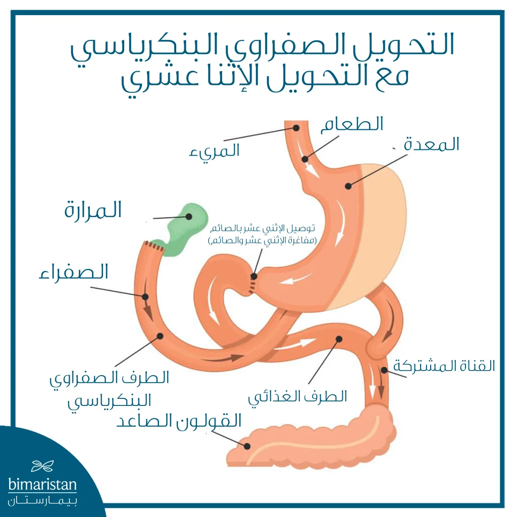 التحويل الصفراوي البنكرياسي مع التحويل الإثنا عشري