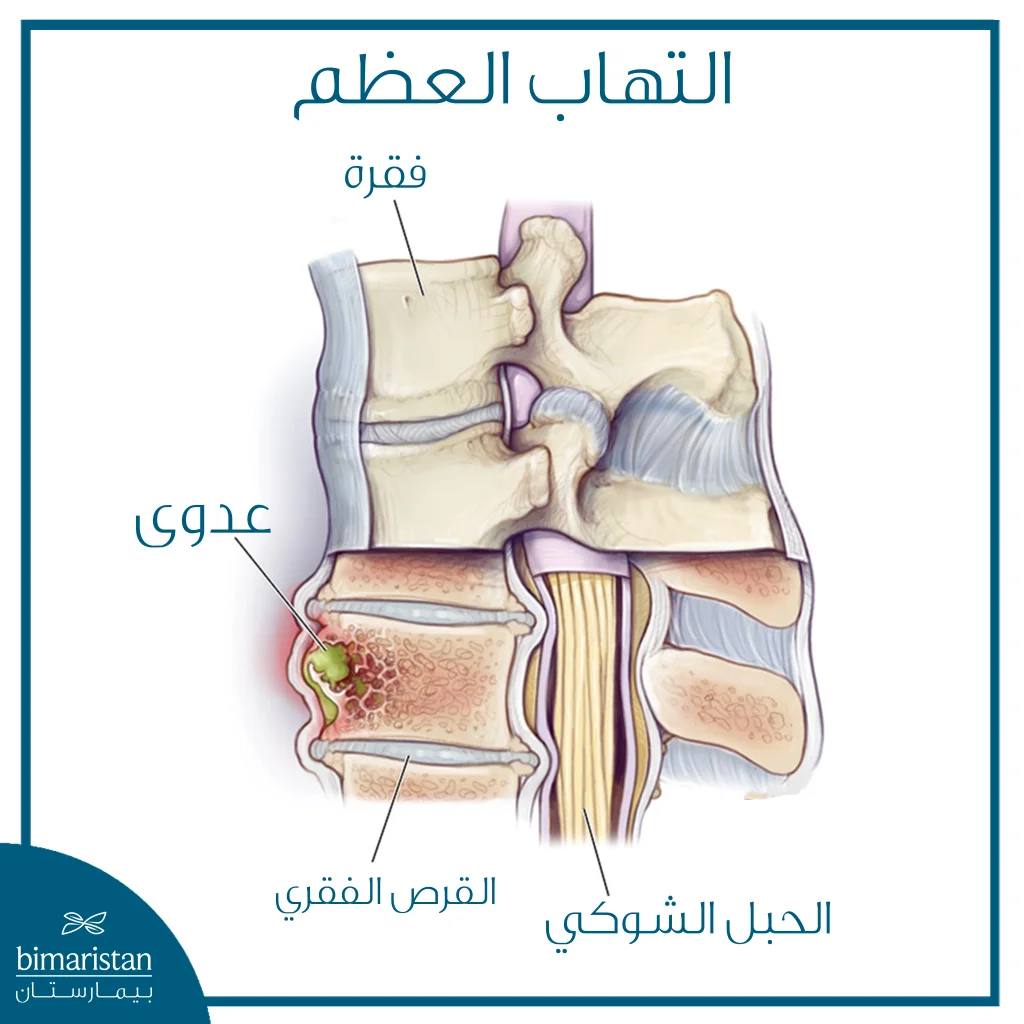 التهاب العظم كل ما تريد معرفته