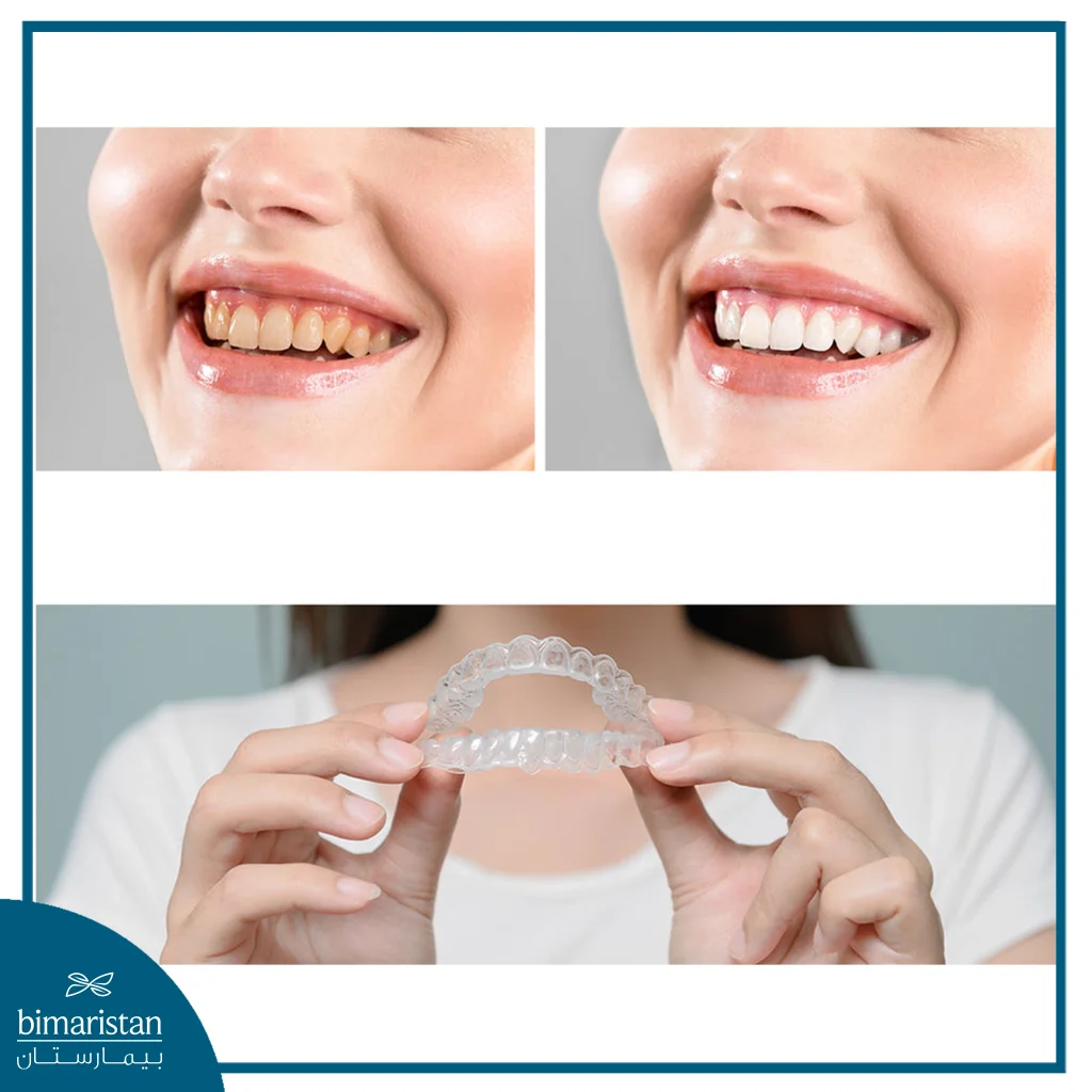 قوالب تبييض الأسنان: الأنواع، طريقة الاستخدام، المزايا والعيوب 2 النتائج قبل وبعد استخدام قوالب تبييض الأسنان