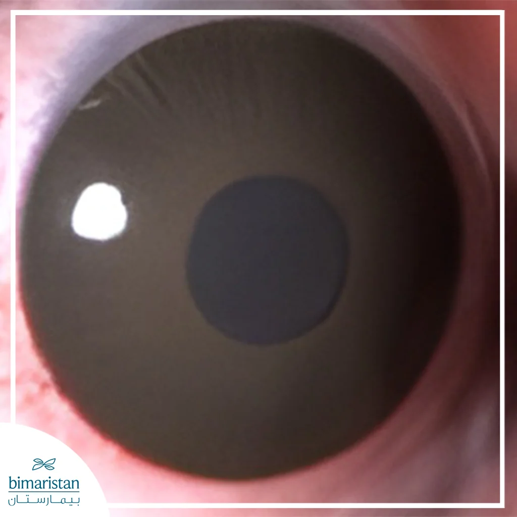 تظهر في الصورة عين ترتدي عدسة لاصقة طبية ذات تصميم ملوّن حول القزحية، حيث تبدو الحدود الدائرية للعدسة واضحة على سطح القرنية