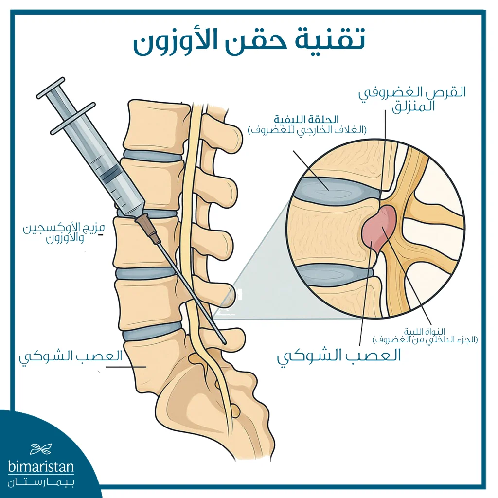 تقنية حقن الأوزون