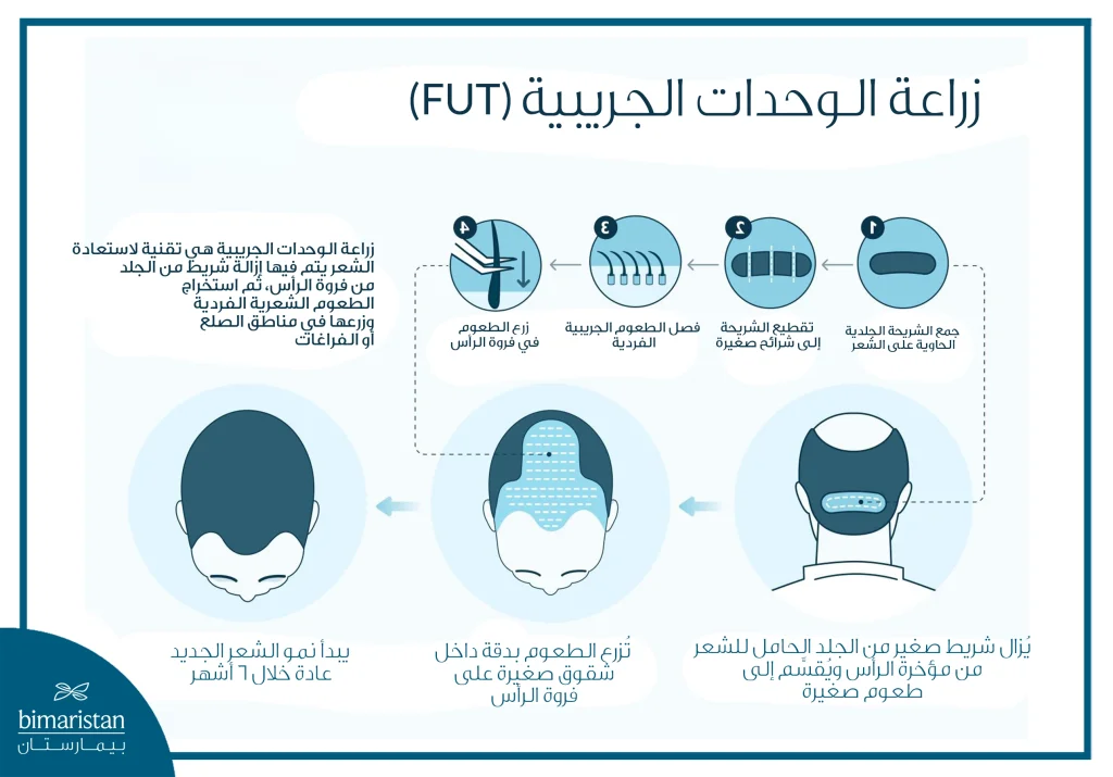 تكلفة زراعة الشعر بتقنية Fut في تركيا 2025: المميزات والخطوات والنتائج 2 تقنية زراعة الشعر بالشريحة (Fut) تعتمد على إزالة جزء من فروة الرأس الحاملة للشعر ثم فصل الطعوم وزرعها في مناطق الصلع.