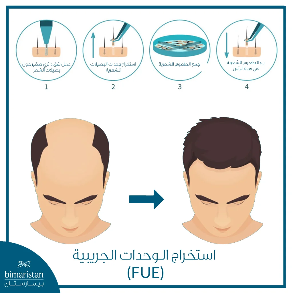 تكلفة زراعة الشعر بتقنية Fue في تركيا: أسعار تنافسية وجودة أوروبية 2 تقنية Fue لزراعة الشعر تعتمد على استخراج البصيلات واحدة تلو الأخرى دون جراحة أو ندبة واضحة.