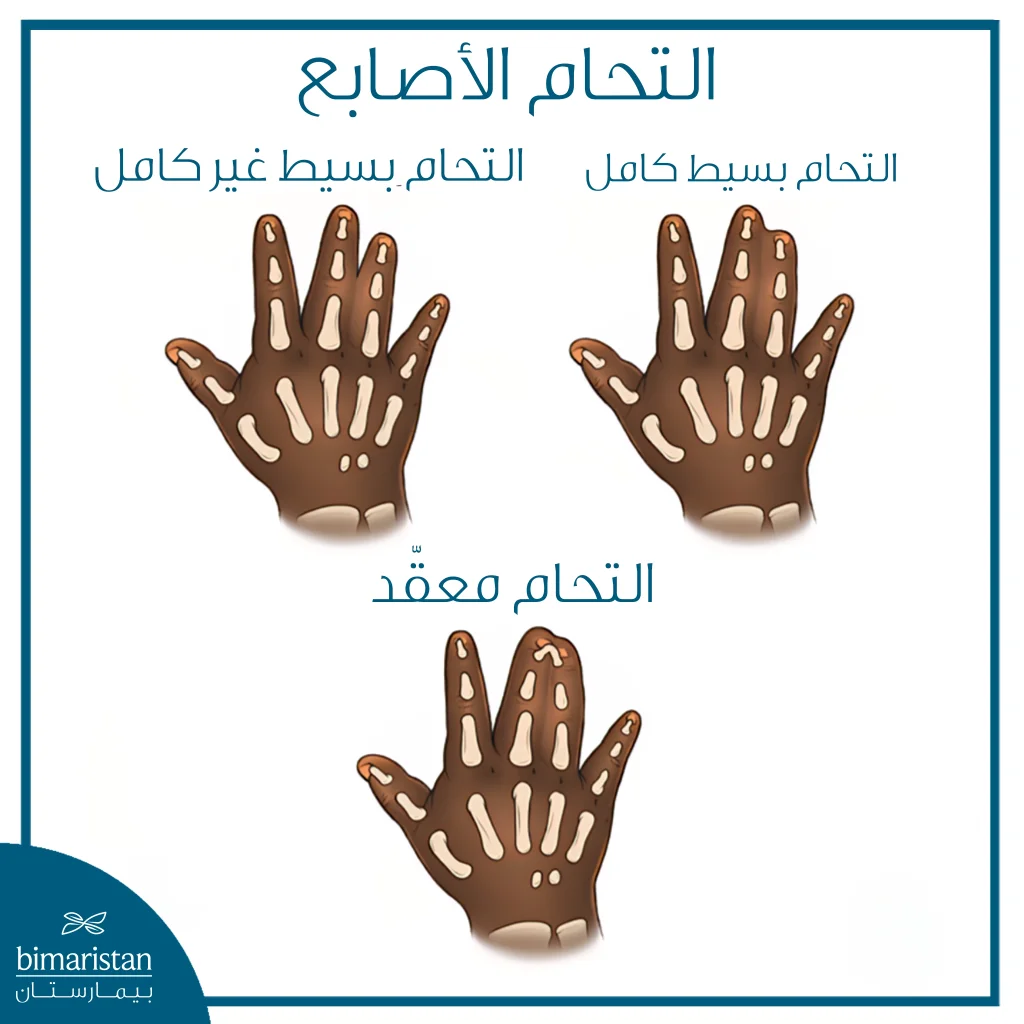 توضح الصورة أنواع التحام الأصابع بسيط جزئي، بسيط كامل، ومعقّد يمتد إلى العظام أو الأوتار.